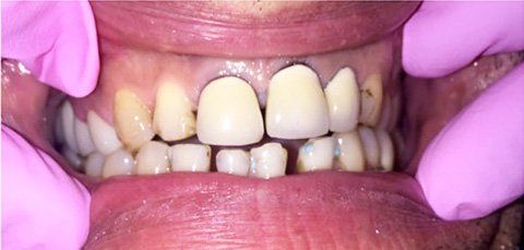 A mouth with several teeth, some are capped. Two gloved hands are pulling the cheeks to show teeth.