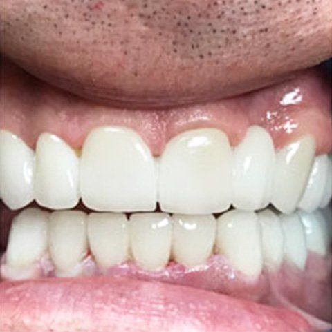 Close-up of someone's mouth with bright, white teeth, possibly dental work.