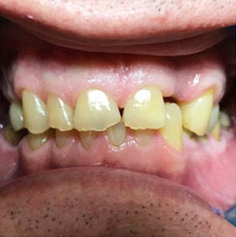 Close-up of a person's mouth, showing discolored, uneven teeth with visible gum line and lower lip.