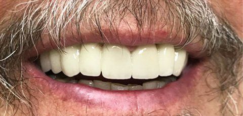 Close-up of a person's smiling mouth, showing bright, even, and possibly prosthetic teeth.