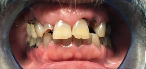 Mouth with yellowed, damaged teeth; some are chipped or missing. Red gums are visible.