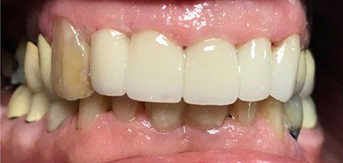 Close-up of mouth showing teeth: yellowed natural teeth with bright, white dental crowns.