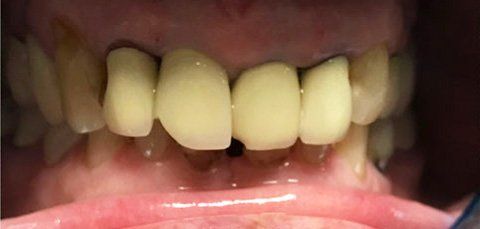 Close-up view of teeth, showing a gap where a tooth is missing. Surrounding teeth are yellowish.