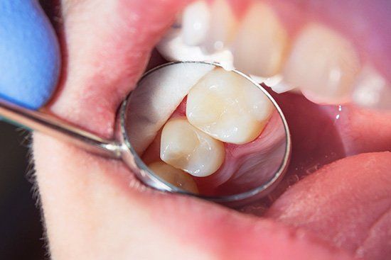 Dental mirror view of upper teeth; pale yellow molars visible.