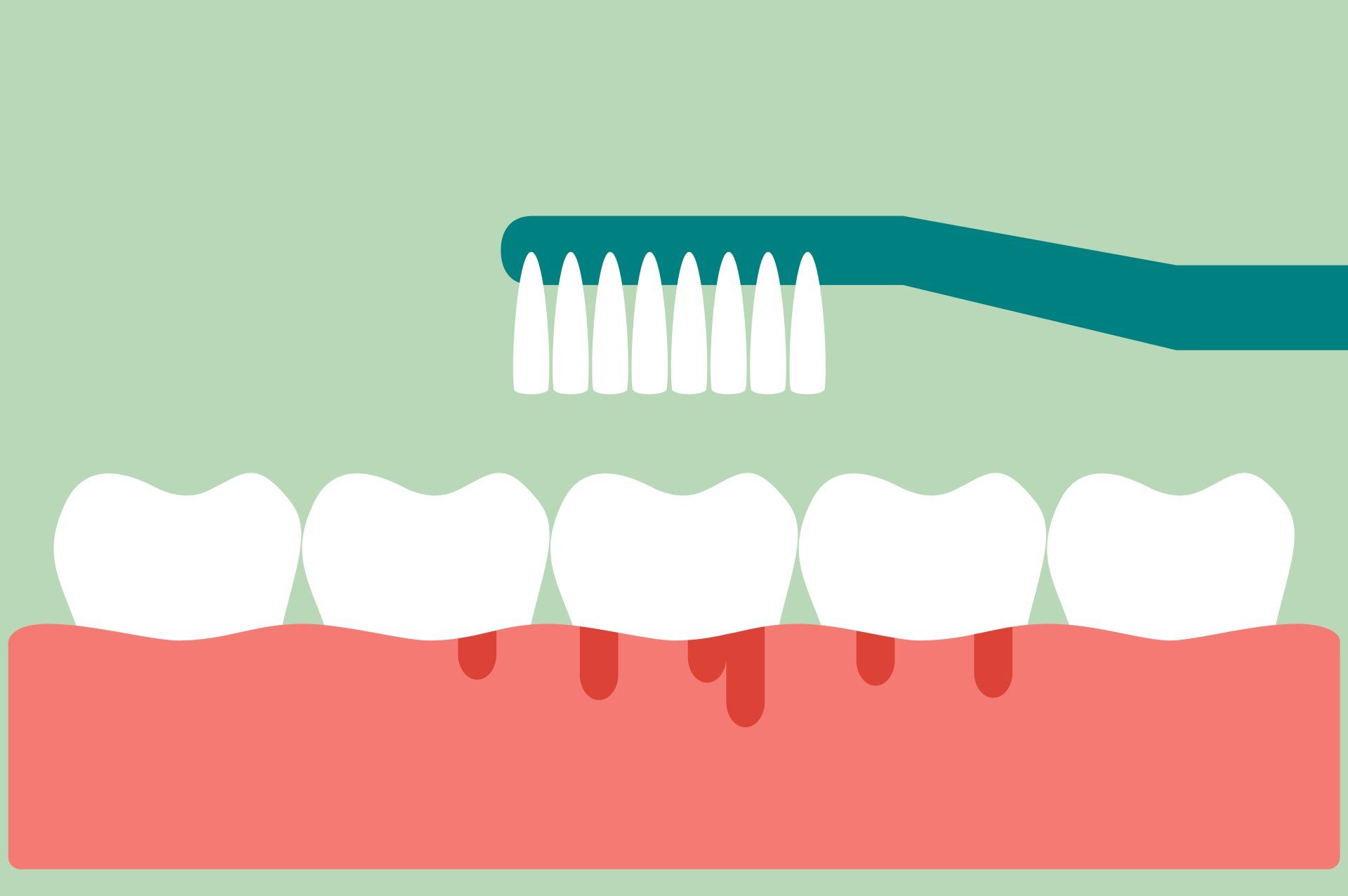 everything-you-need-to-know-about-bleeding-gums