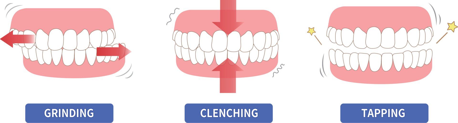 Bruxism Teeth Grinding