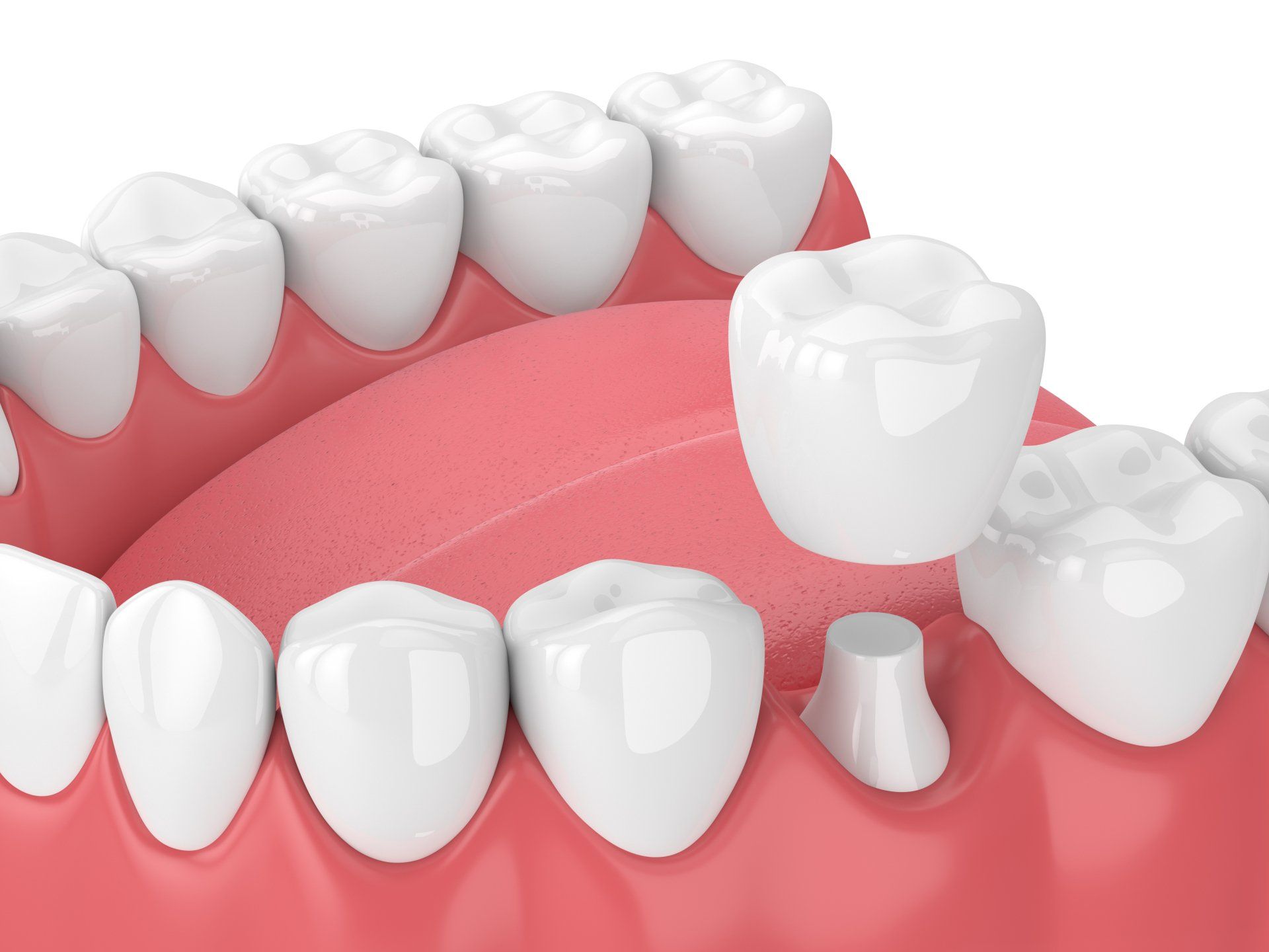 dental crown material