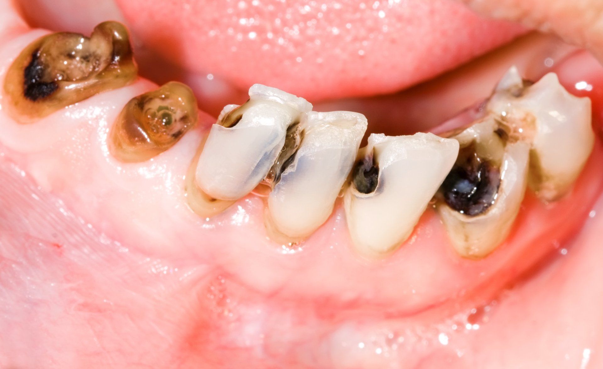 symptoms of tooth decay
