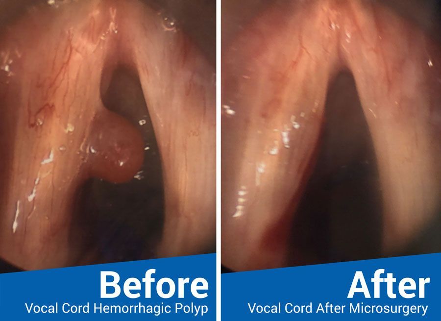 a before and after picture of a vocal cord hemorrhagic polyp