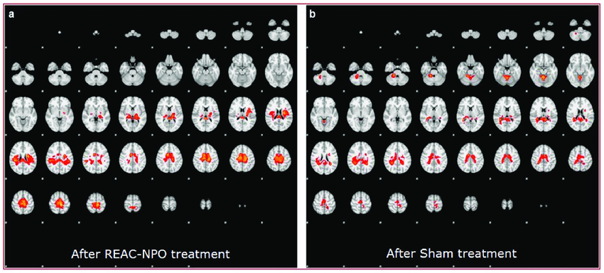 REAC Neuroestimulação e Neuromodulação em São Paulo