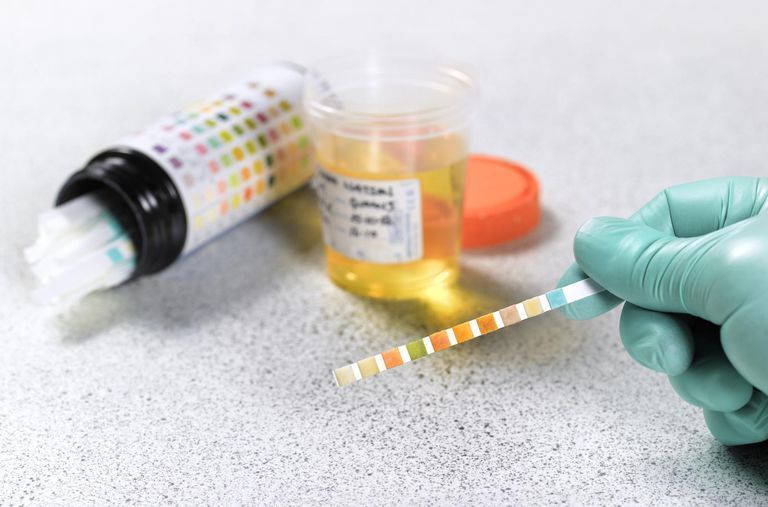 A person is holding a test strip in front of a cup of urine.
