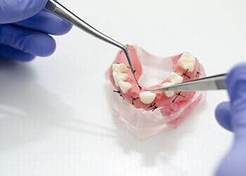 Dental implant — Complete Dentures in Bend, OR