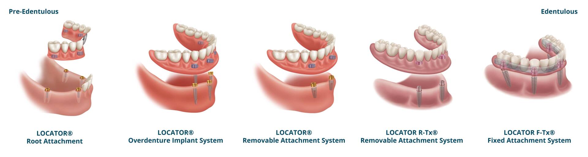 Implant Denture, permanent denture, overdenture