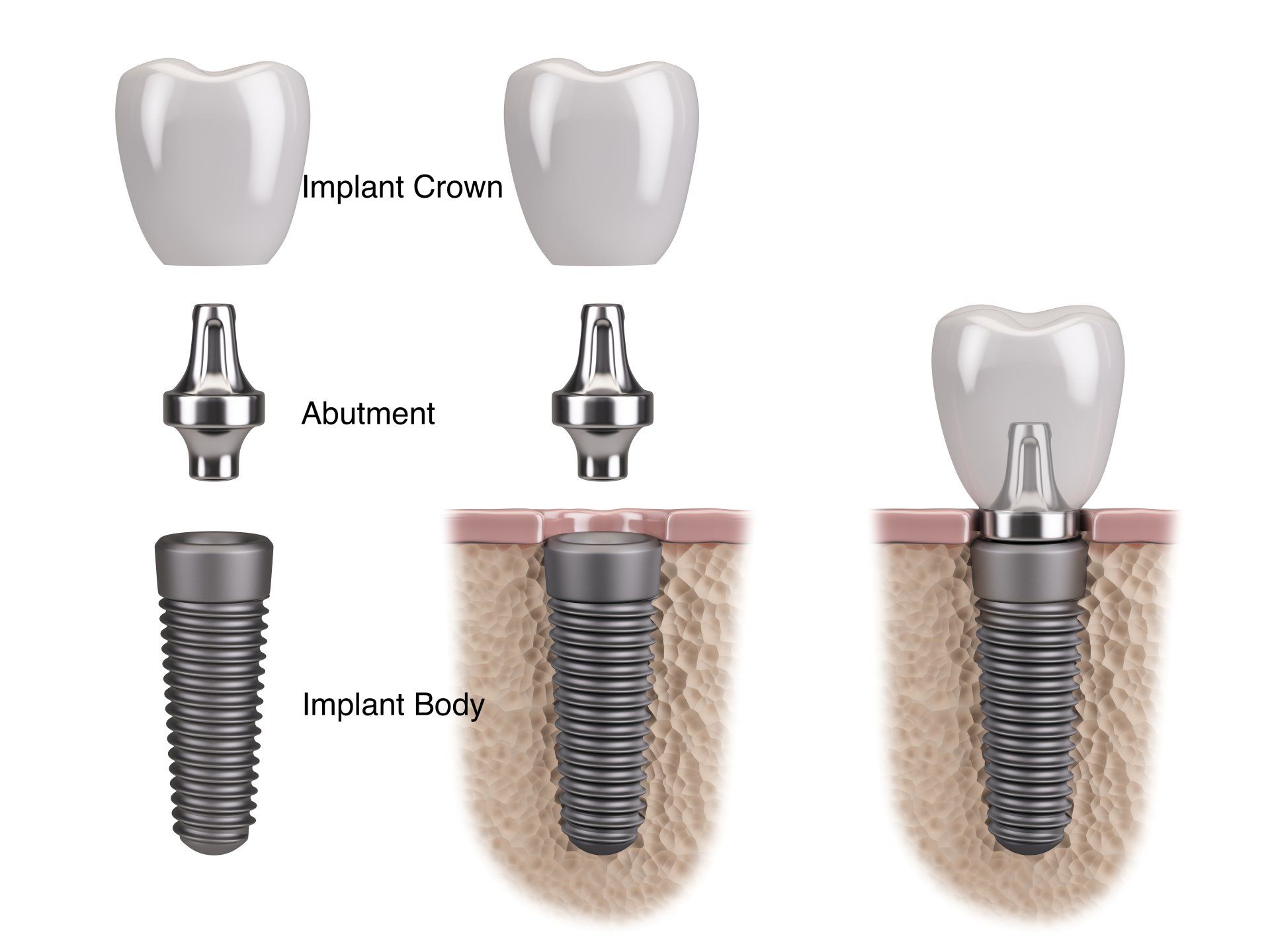 An image showing the process of dental implants in Port St. Lucie, FL
