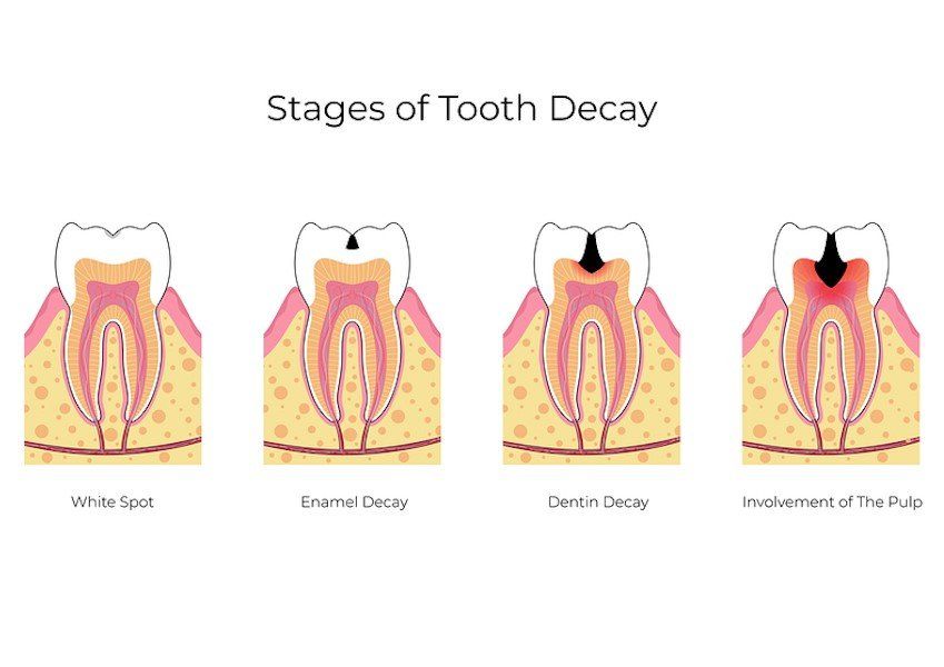 General Dentistry Root Canal-Best Dentist - Port St Lucie, FL - St. Lucie Ctr Cosmetic Dentist