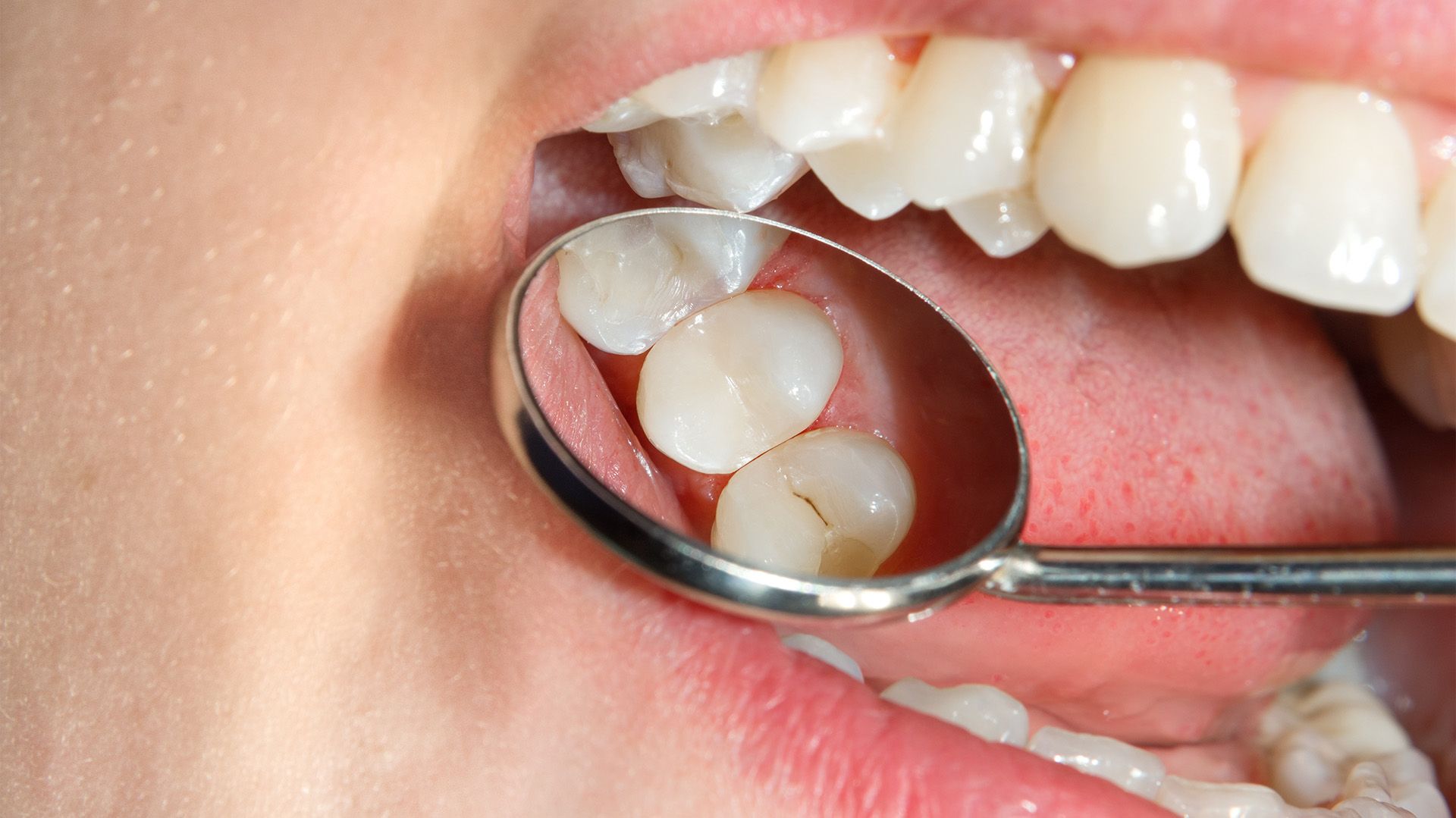 How Dental Sealants Work and Their Benefits