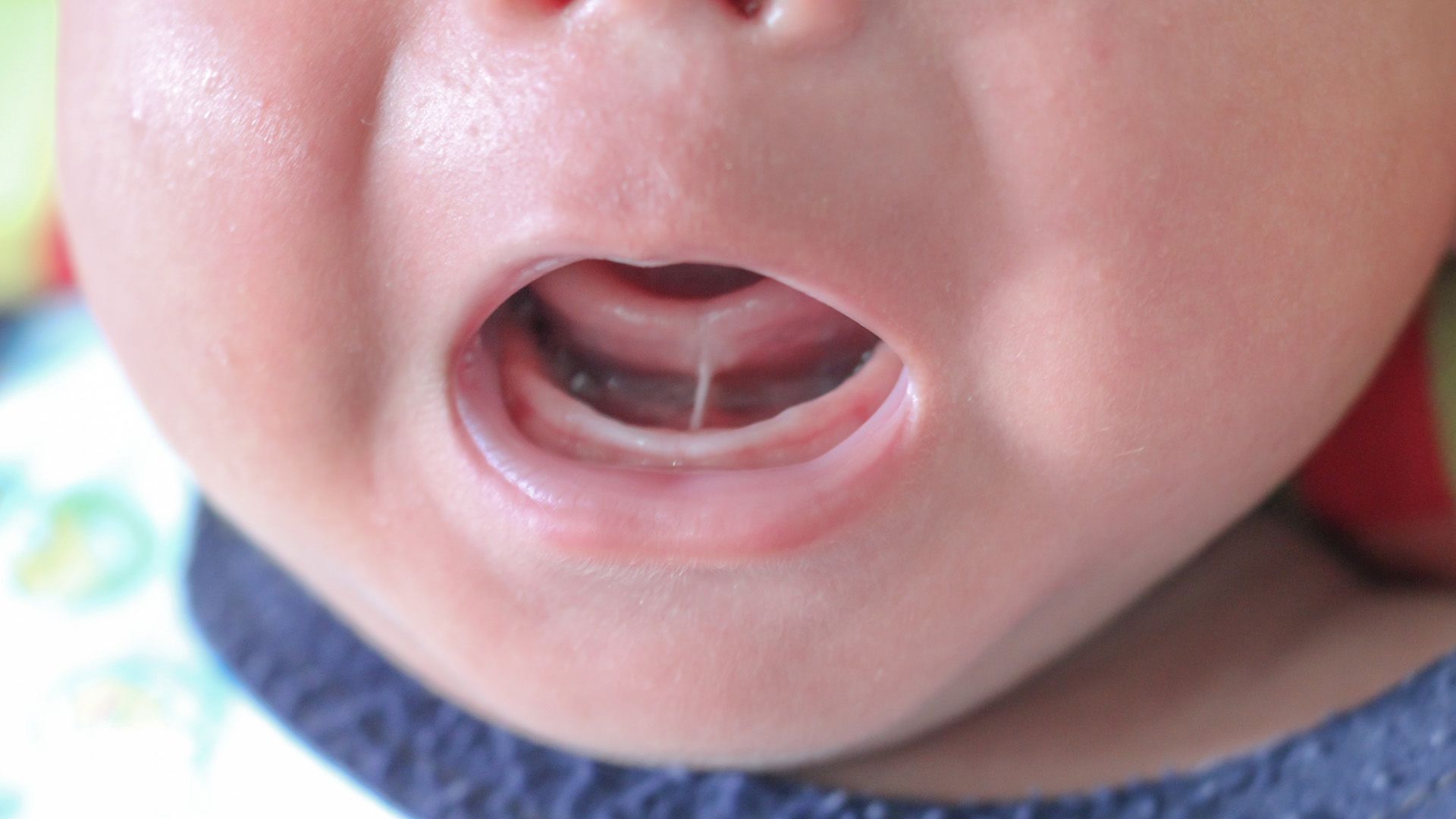 tongue-tie in children