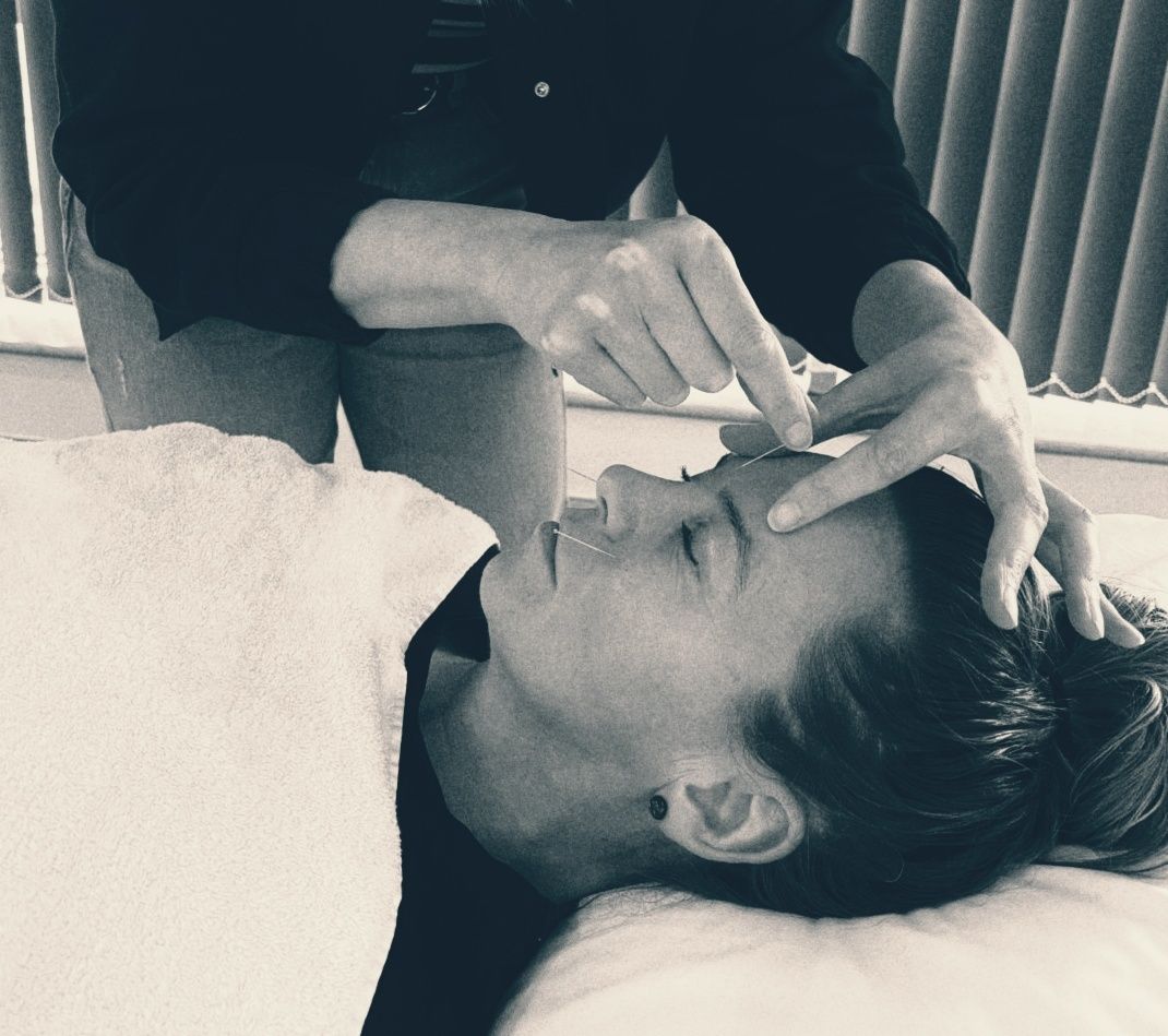 A lady is having acupucture