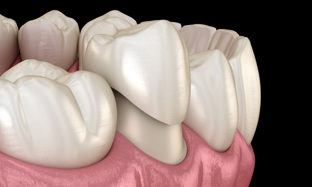 Dental Crown 101 Exploring The Types Procedure And Aftercare For A Stronger Healthier Smile