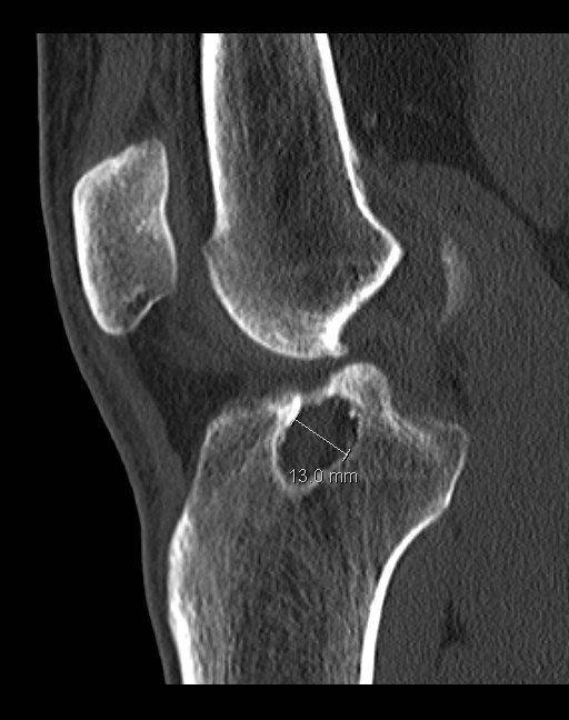 Revision Anterior Cruciate Ligament (ACL) Reconstruction Dr A