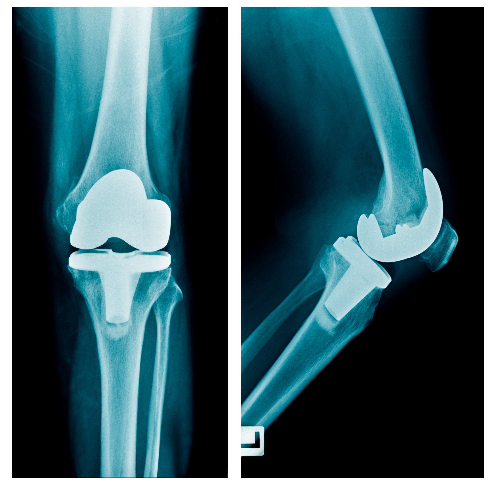 research article on knee replacements