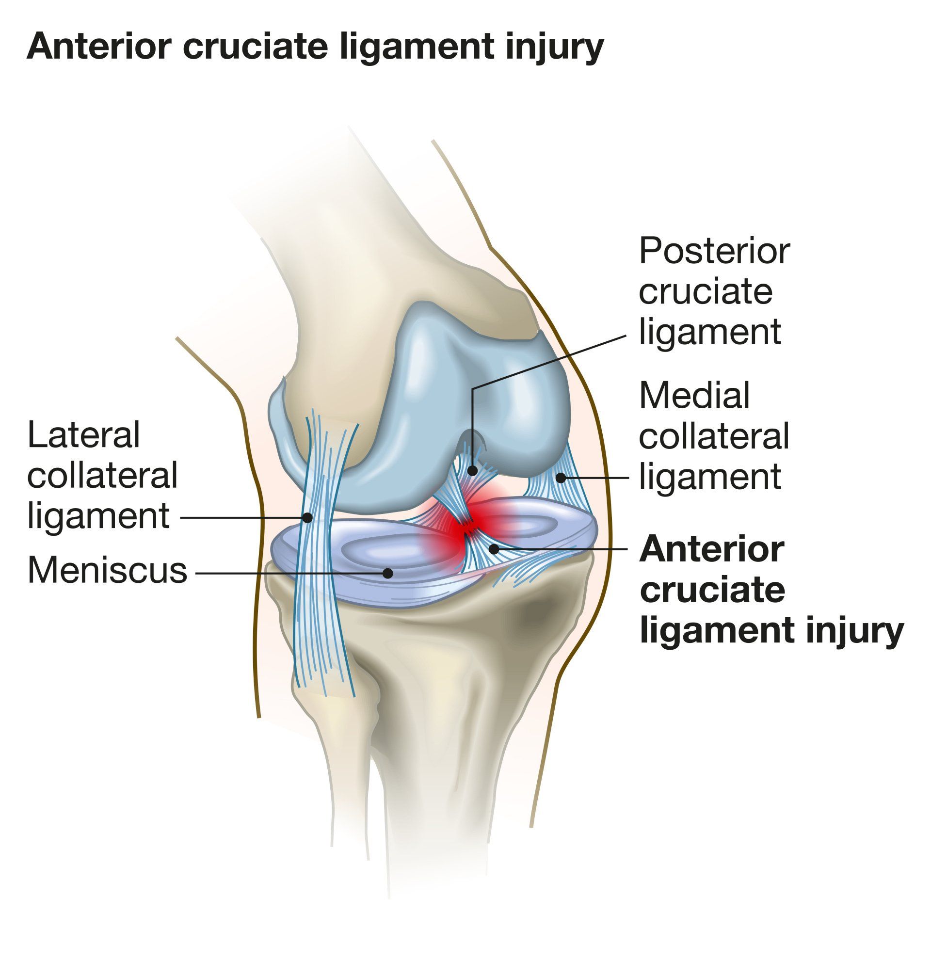 Anterior Cruciate Ligament Rehabilitation Treatment Dr A Theodorides