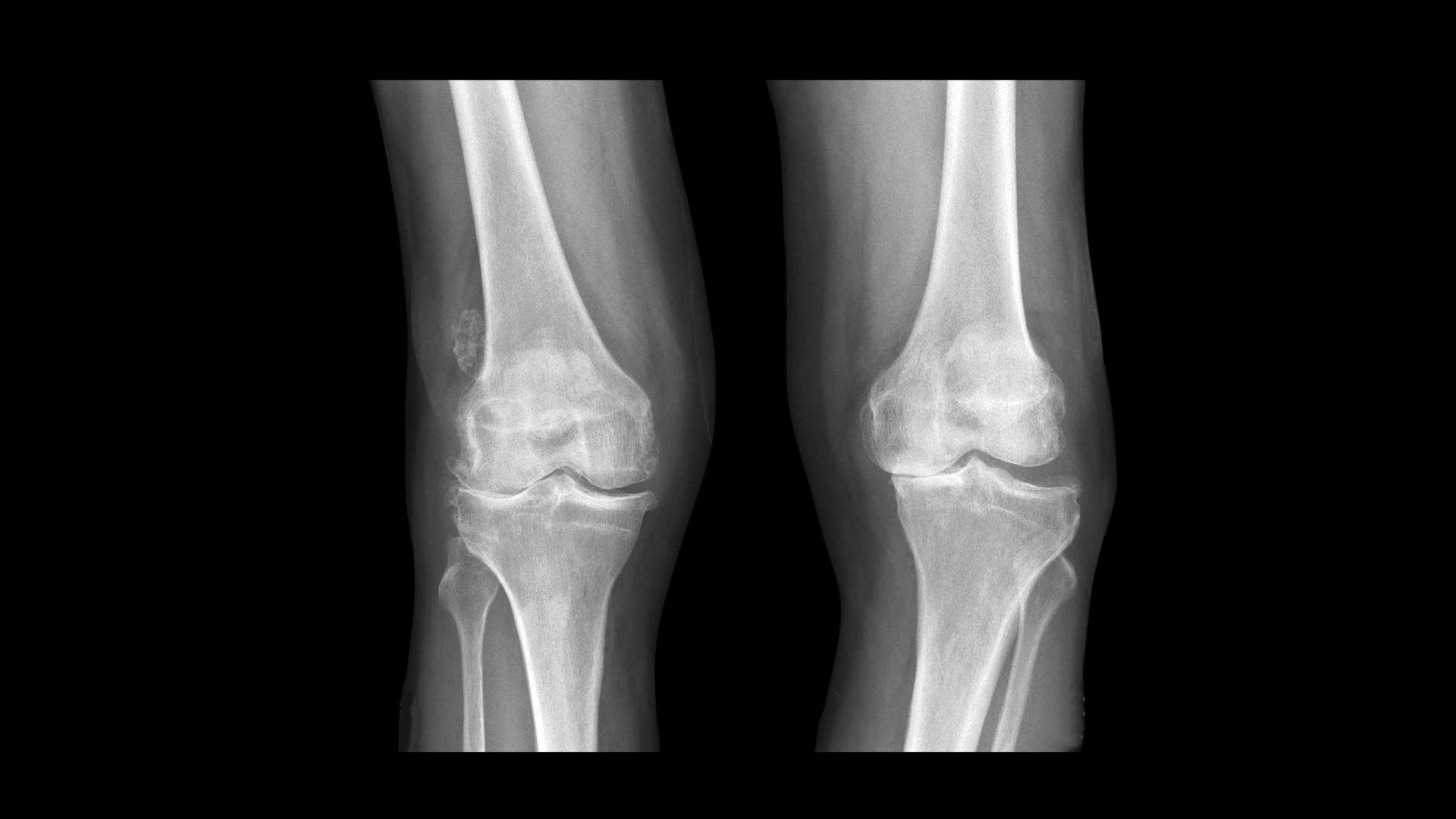 Lower Limb Malalignment Symptoms And Treatment