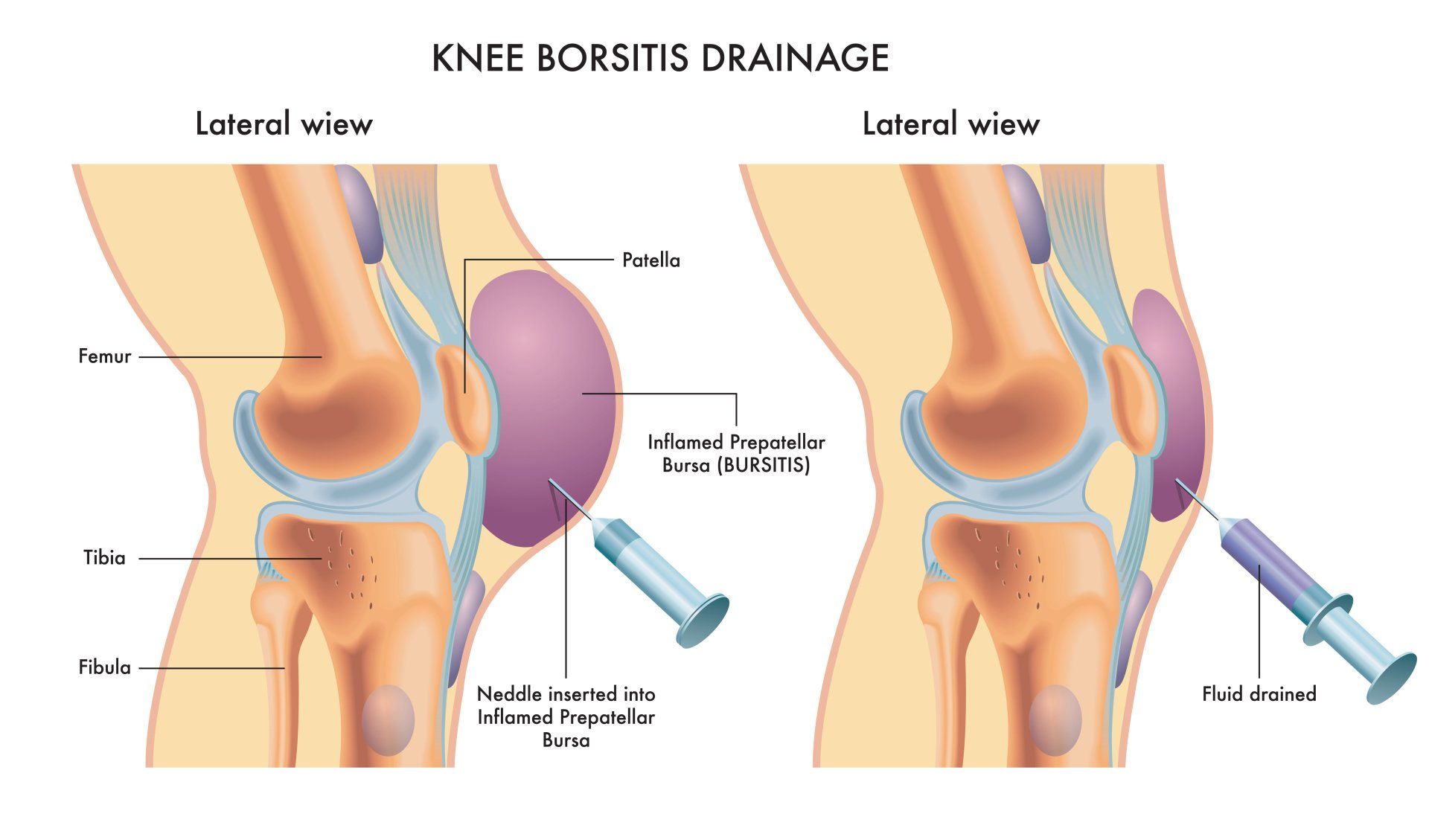 Bursitis Knee Surgeon Dr A Theodorides Symptoms Diagnosis Treatment 0589