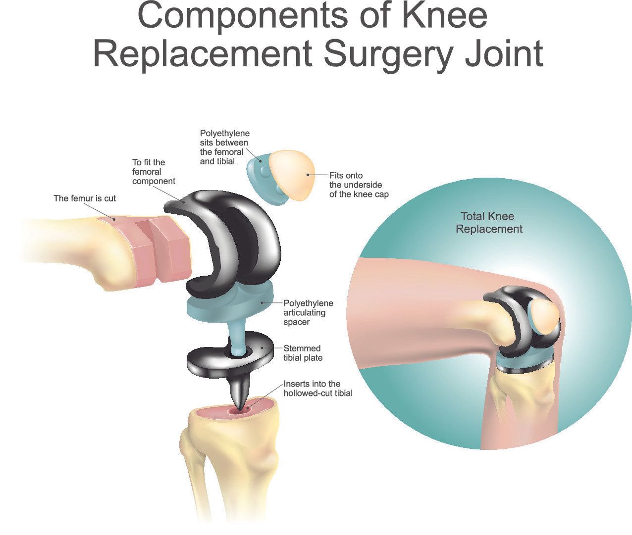 Total Knee Replacement (TKR) Dr A. Theodorides Knee Surgeon Specialist