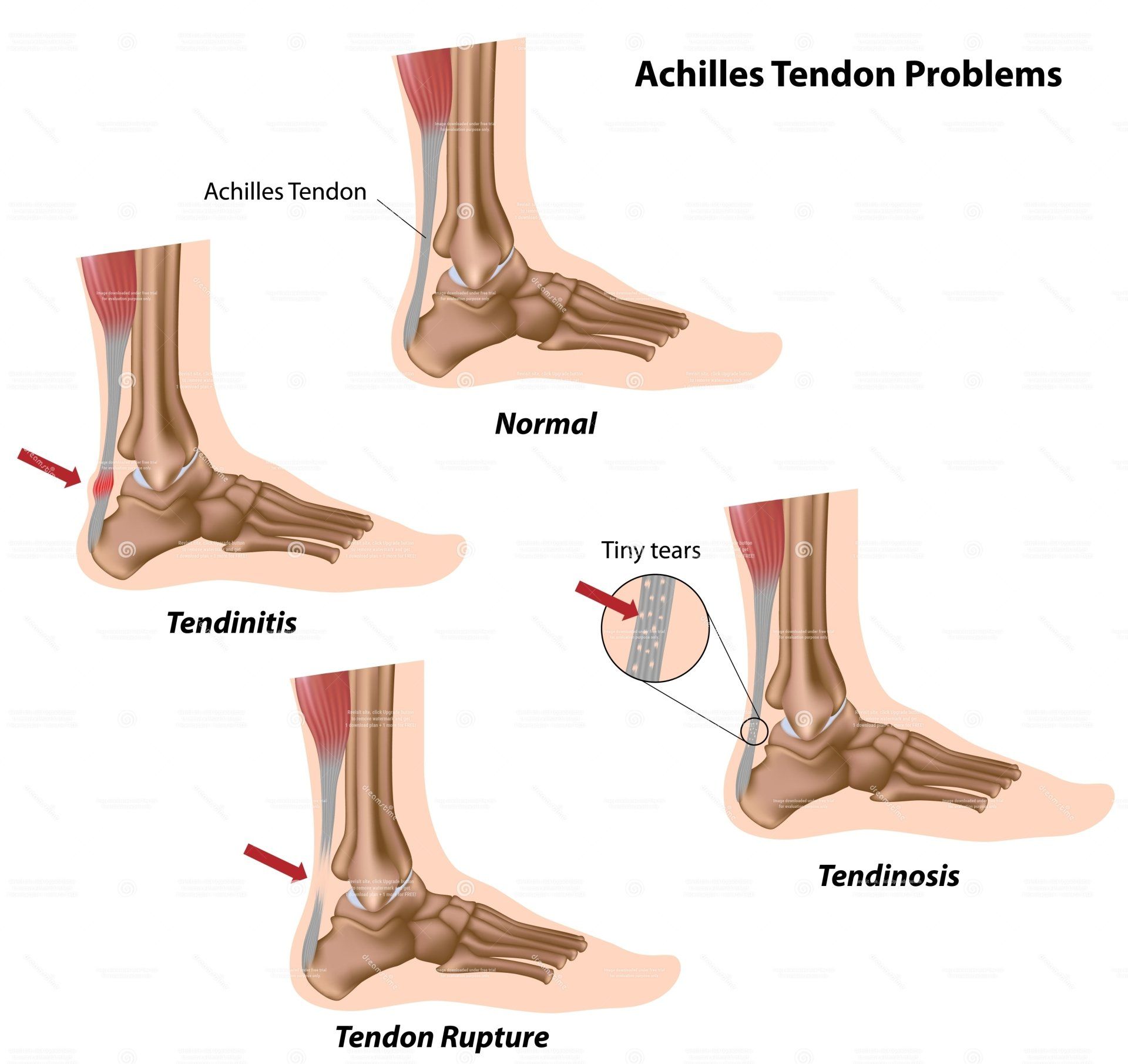 Repetitive Strain Injury