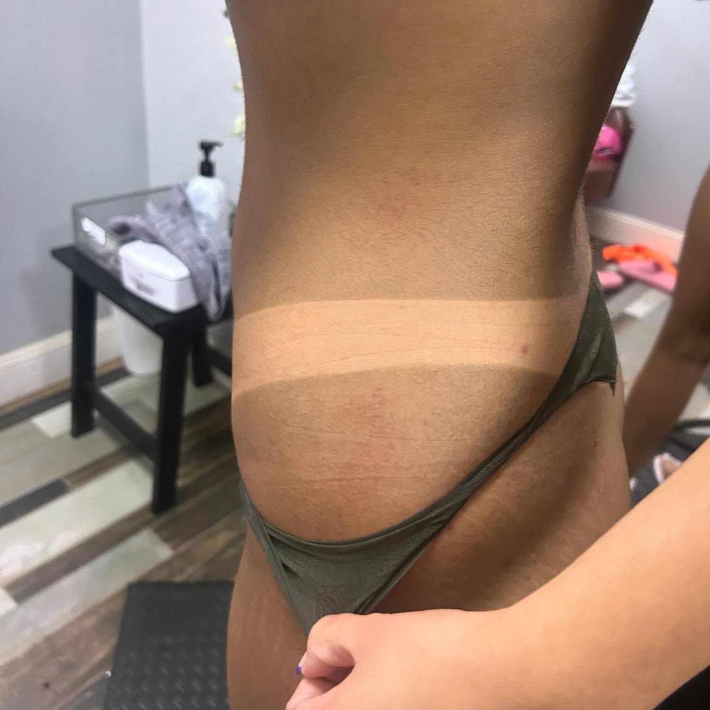 Person with tan lines on side in bikini bottom, being examined.