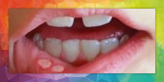 Canker sores and homeopathy