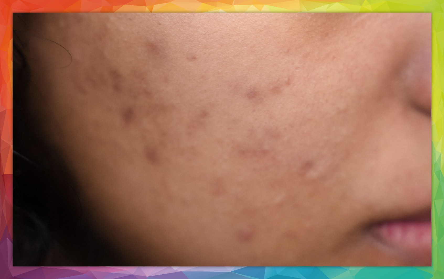 cystic acne- in acupuncture