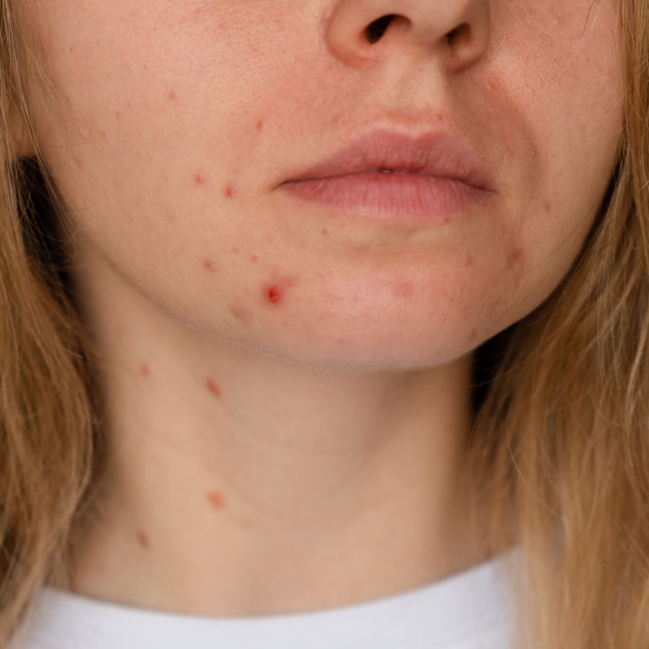 A close up of a woman's face with acne on it