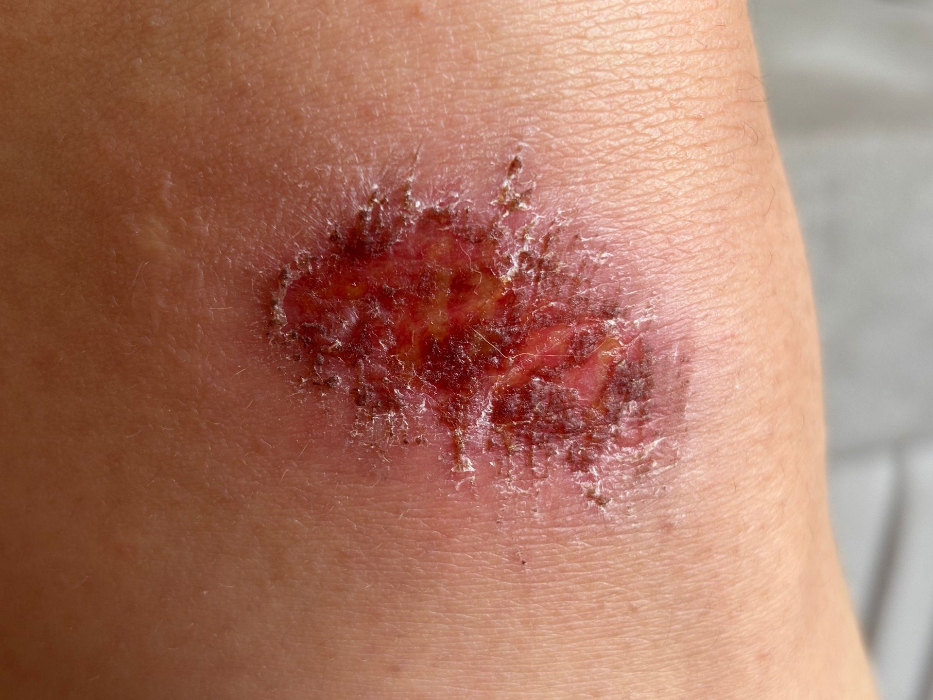 Abrasion wound on skin, red and irritated with surrounding pale skin.