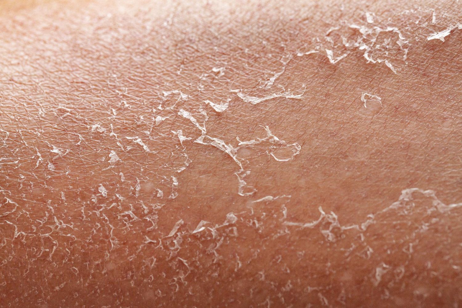 peeling TCA
