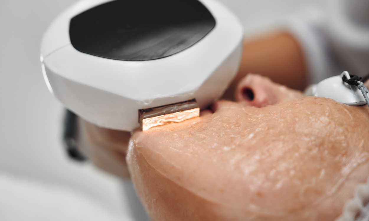 lumiere pulsée IPL medecine esthetique