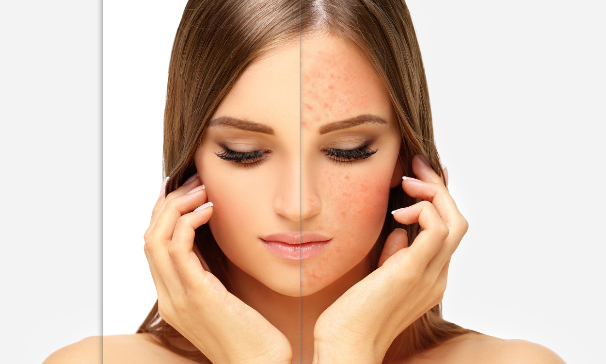 La lumière pulsée intense (IPL) est un traitement médical non invasif qui corrige les taches pigment