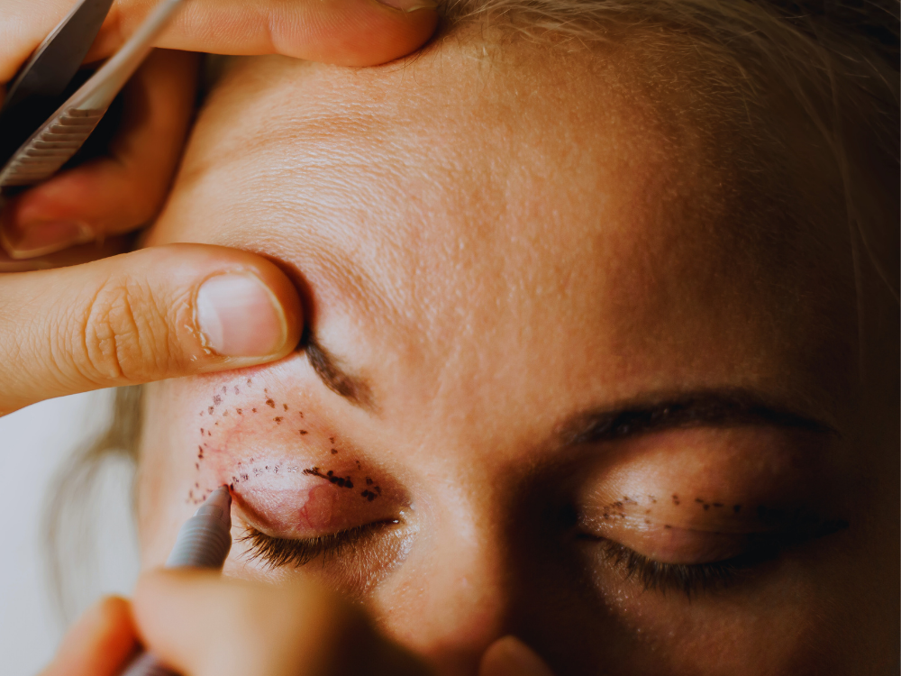 Blépharoplastie médicale SilkPlex à Rouen : retendre les paupières sans chirurgie grâce au laser CO₂