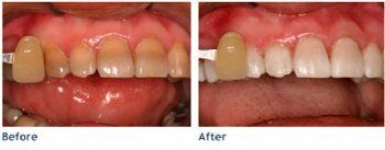 Teeth Whitening Deep Bleaching - Before & After 1