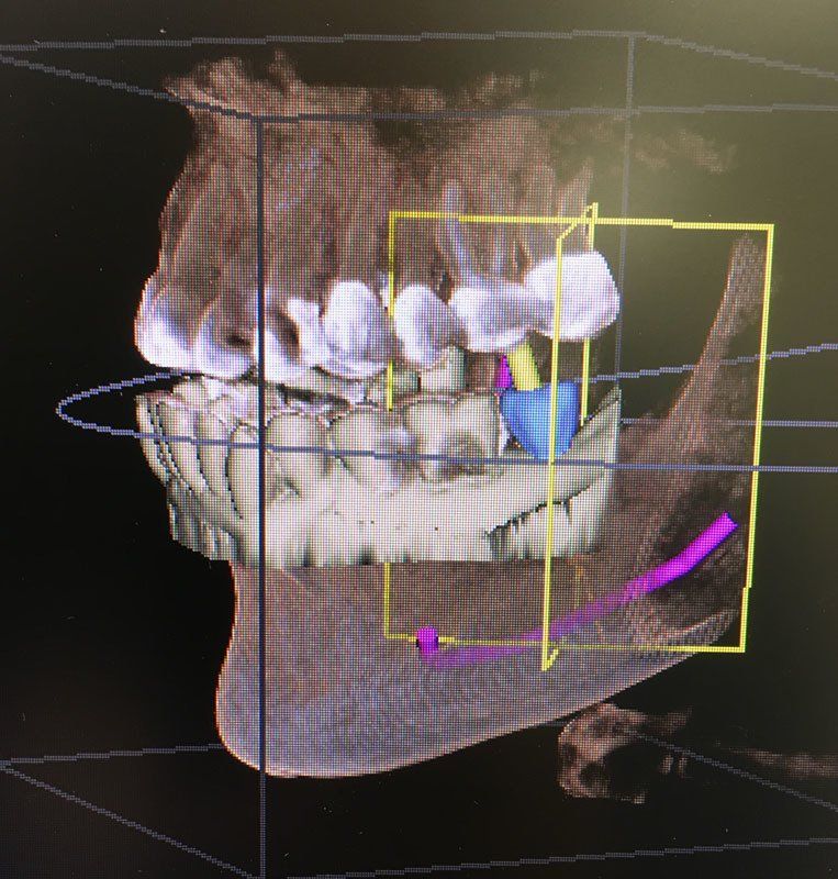 CEREC CROWNS 5
