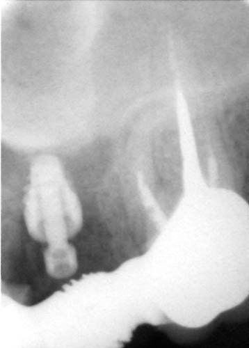 radiografia dentale