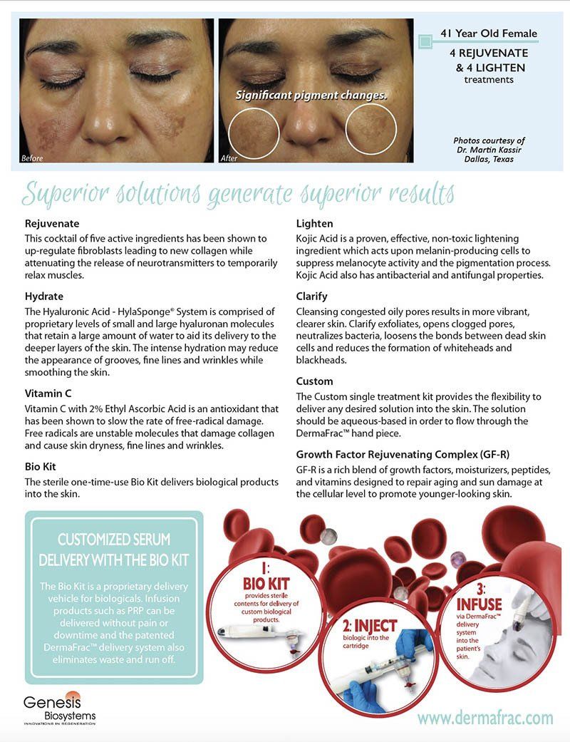 Dermafrac MicroNeedling advanced micro-needling system on the market