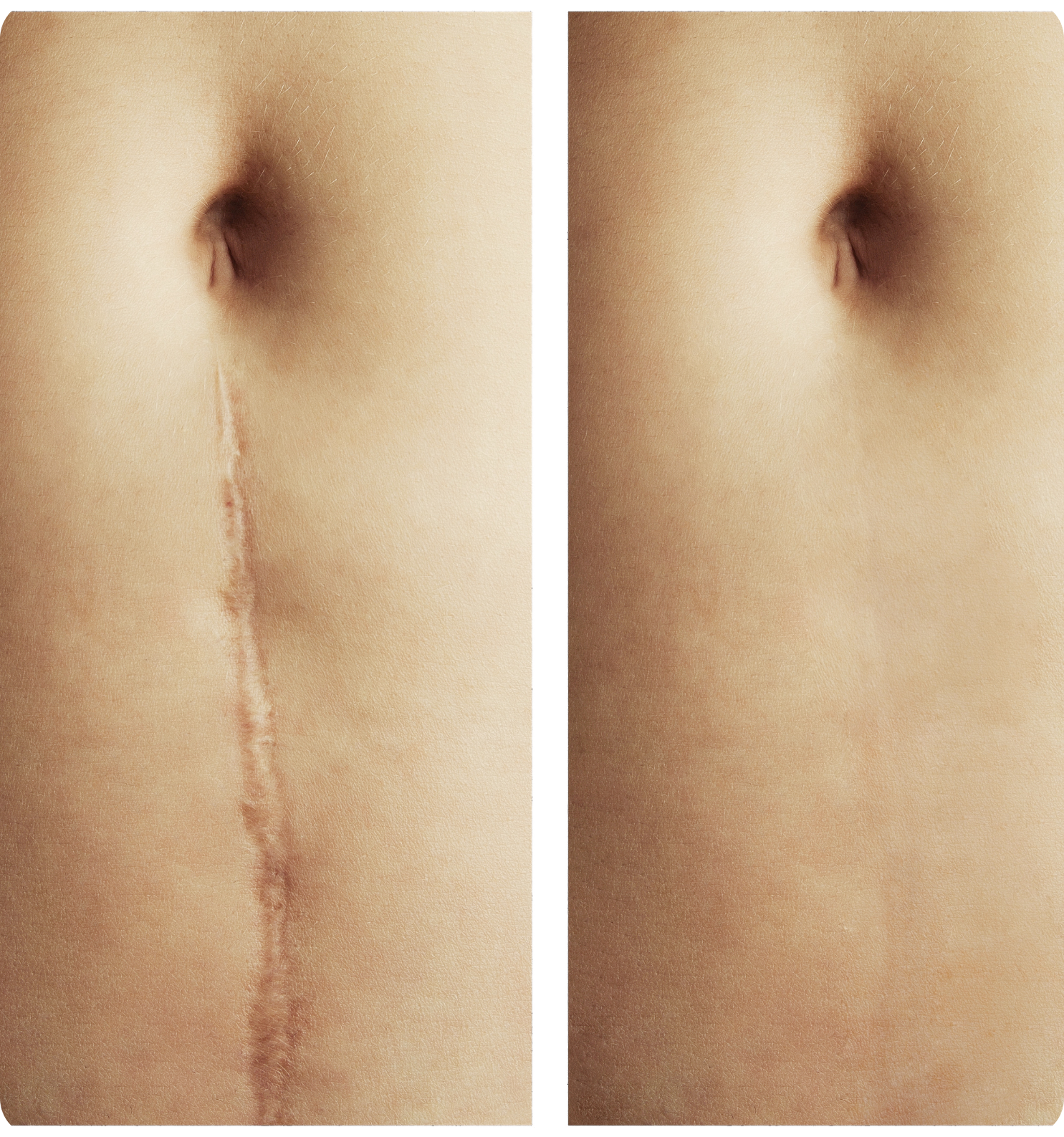 Ein Vorher-Nachher-Bild vom Bauch einer Frau mit einer Narbe