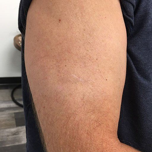 A close up of a man 's arm with a scar on it.