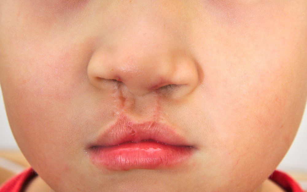 Boy with Repaired Cleft Palate