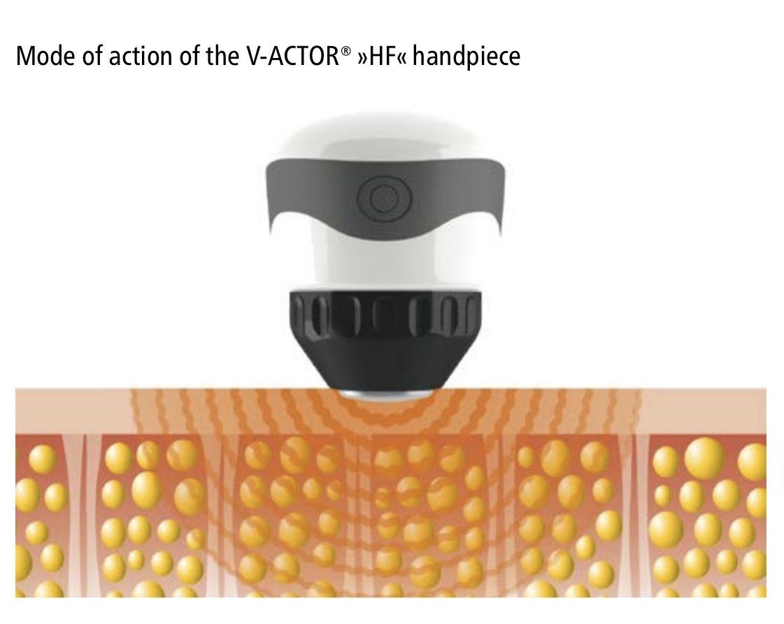 Hove Shockwave Therapy