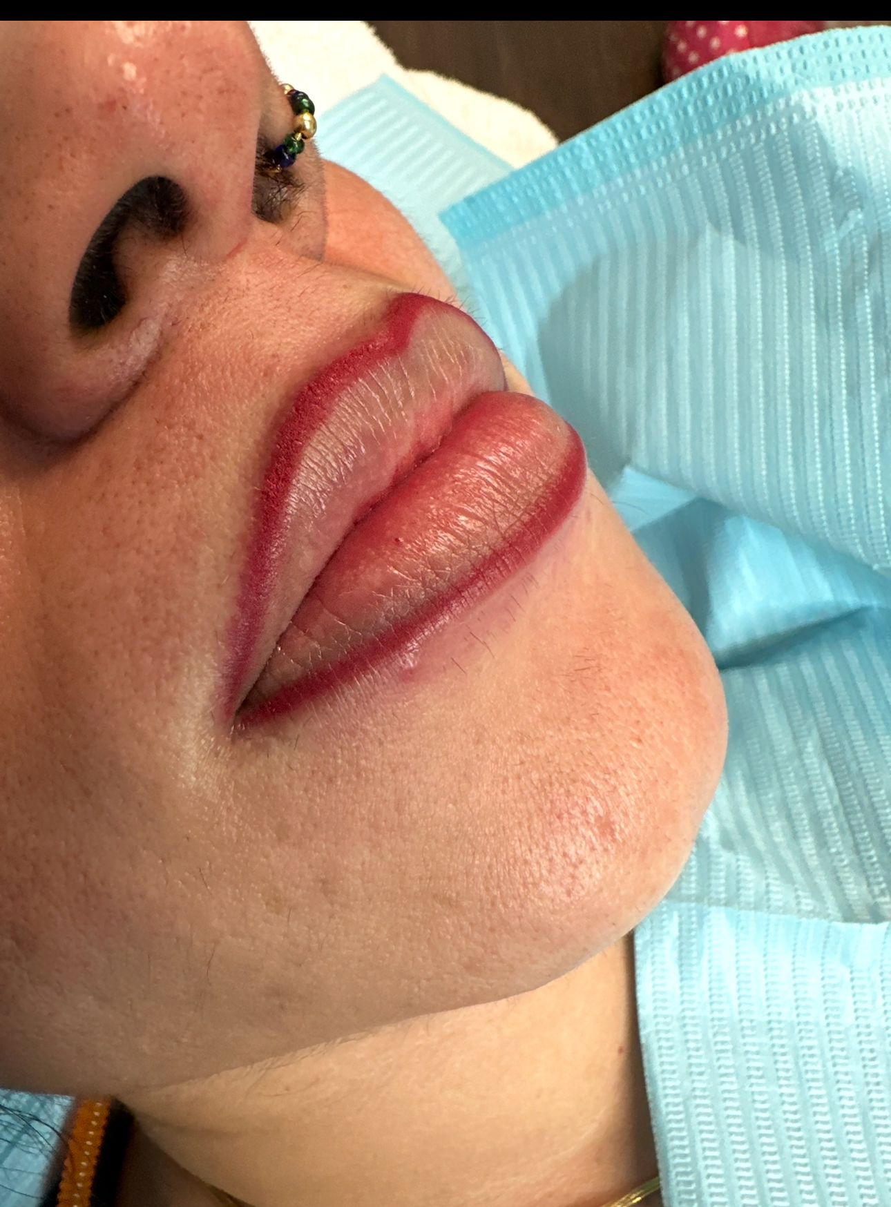 Close-up of a person's lips with a reddish outline, possibly after a lip tattoo procedure, on a medical blue drape.
