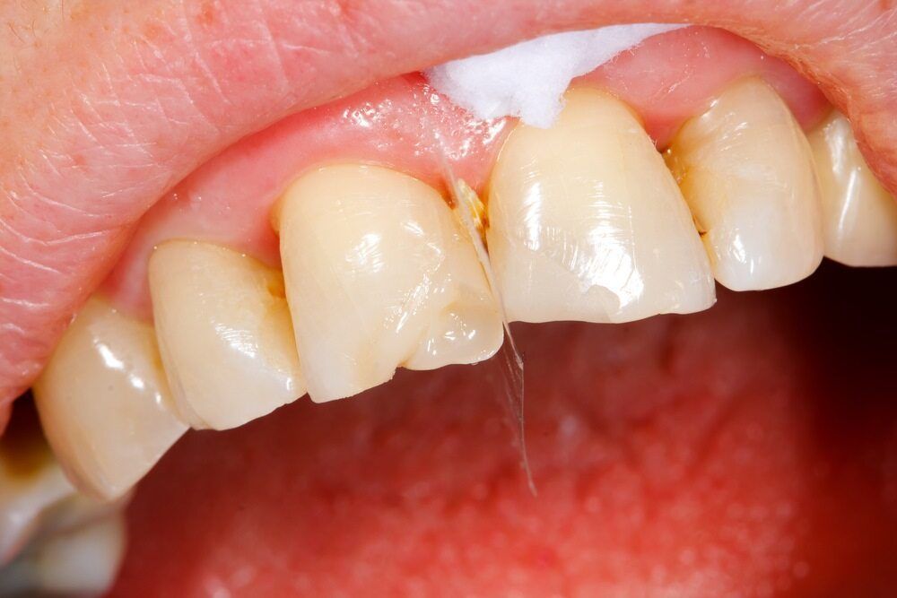 A Close Up of a Person's Teeth With Toothpaste on Them — Parap Family Dental in Parap, NT