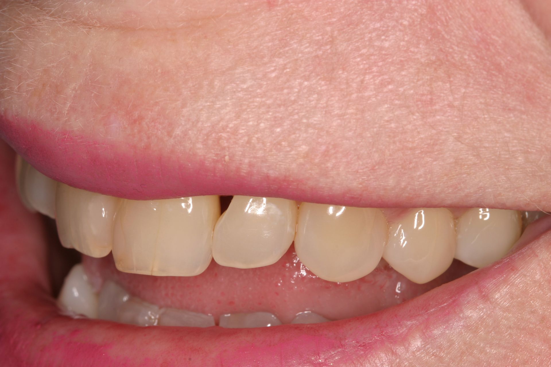 Before Close Up Of A Persons Teeth — Dr Patrick Meaney In Moss Vale, NSW